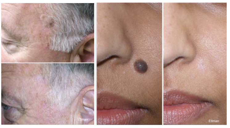 Mole Removal Before and After