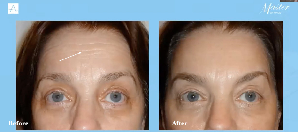 Wrinkles on Forehead Removal