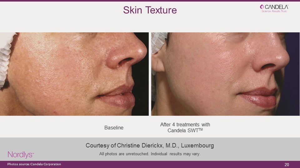 skin texture laser treatment laser skin resurfacing 
