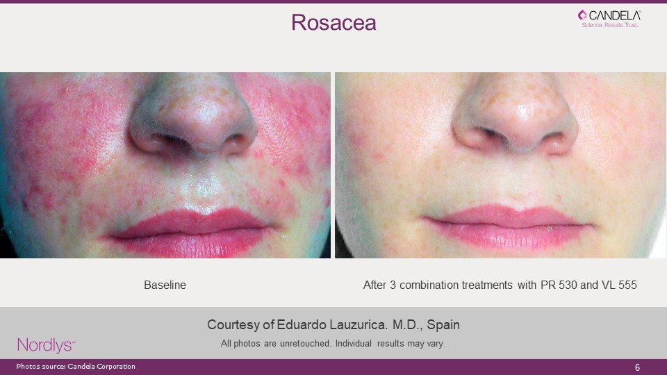 rosacea laser vein removal 