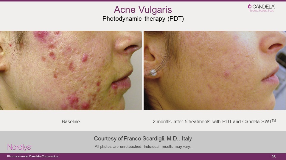 acne vulgaris laser treatment