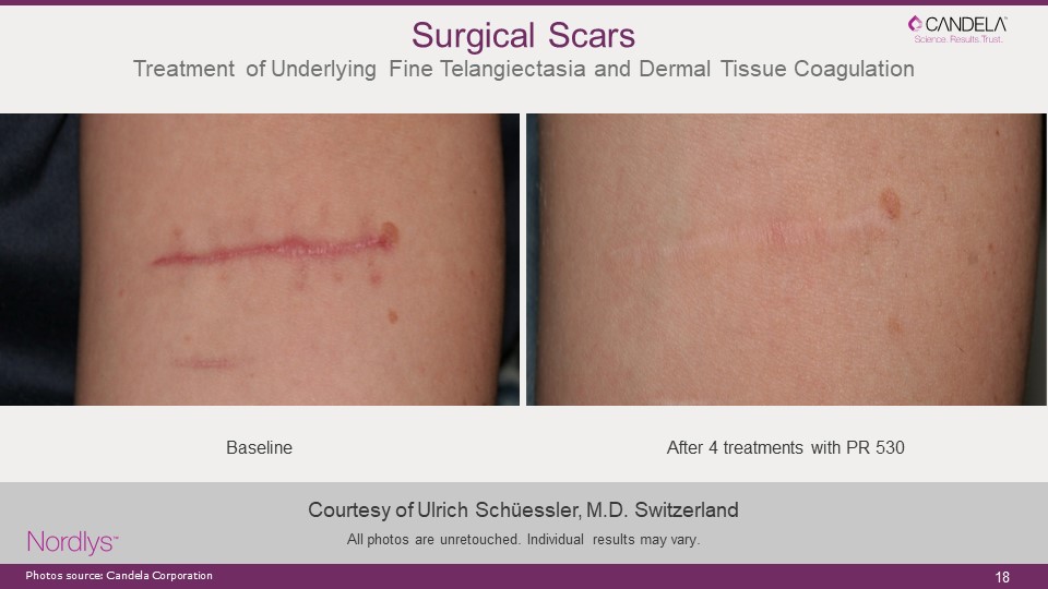 laser treatment surgical scars