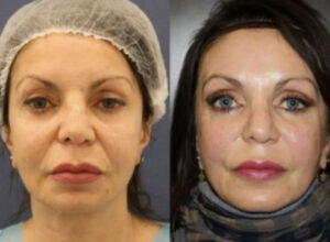 Before and After Face Surgery