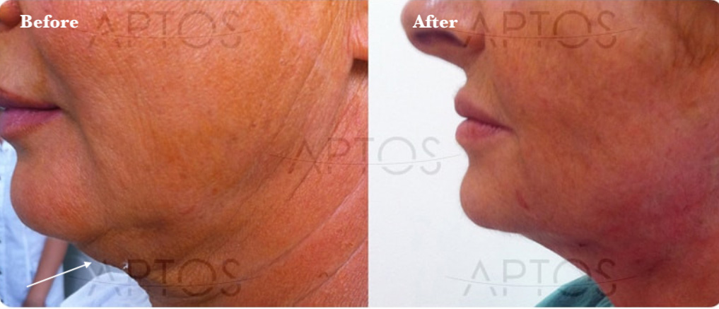 Wrinkles on Chin Removal