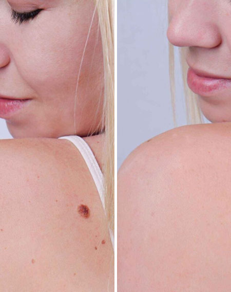 Age Spot Removal