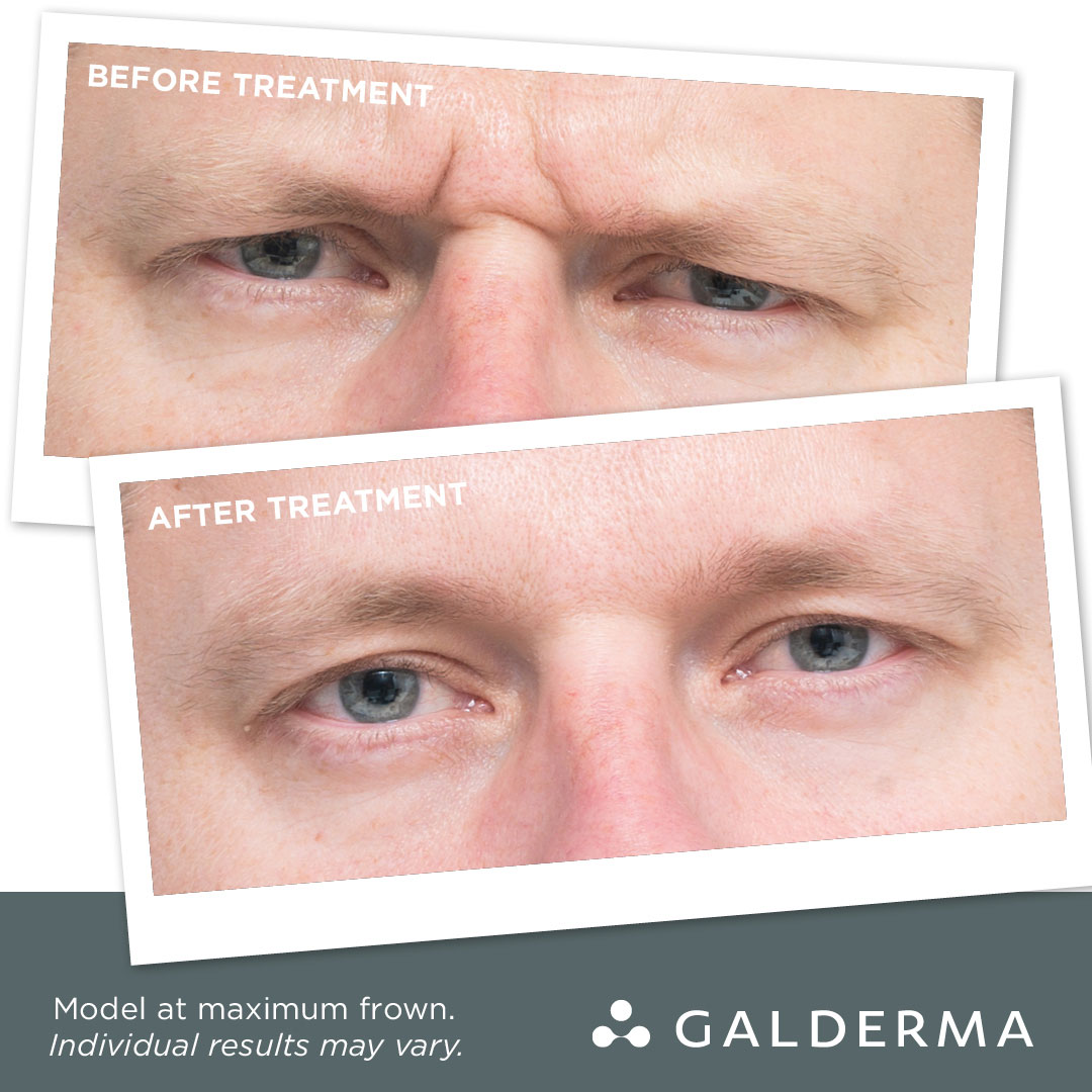 Frown Lines Treatment on Men