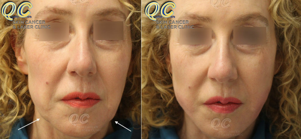 Skin treatment on face before and after