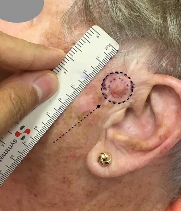 Mole on skin near ear