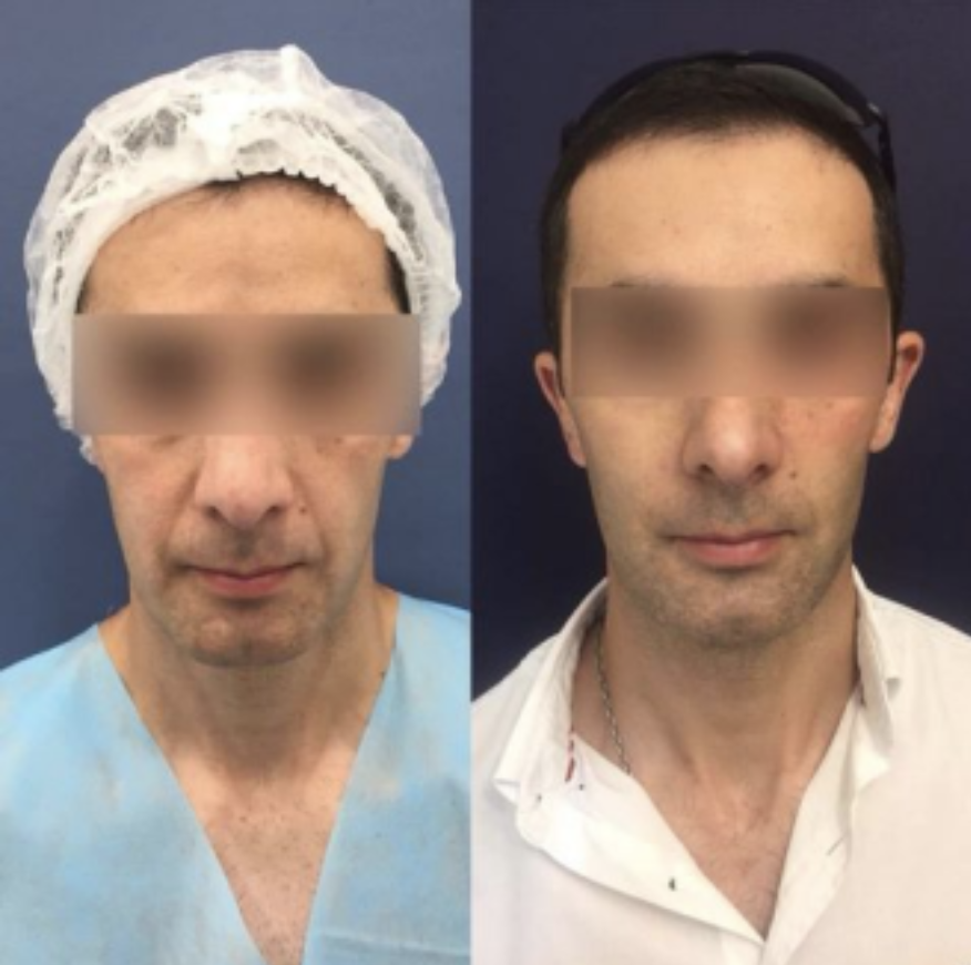 Non Surgical Facelift Before and After
