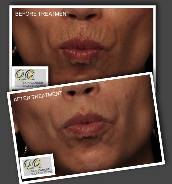 Upper Lip Lines Treatment