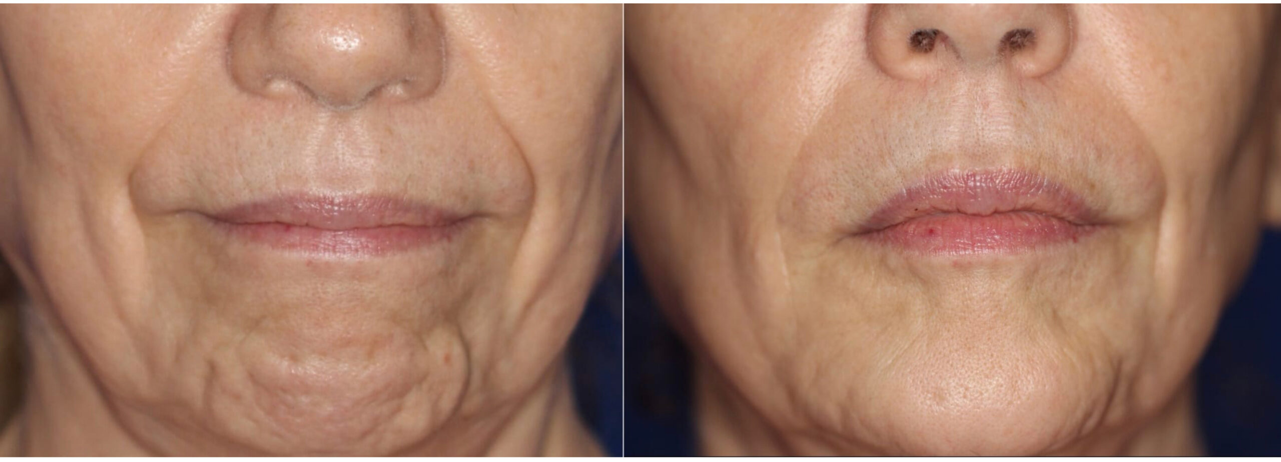 Dimpled Chin Treatment