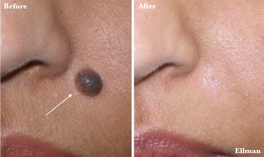 Mole removal before and after