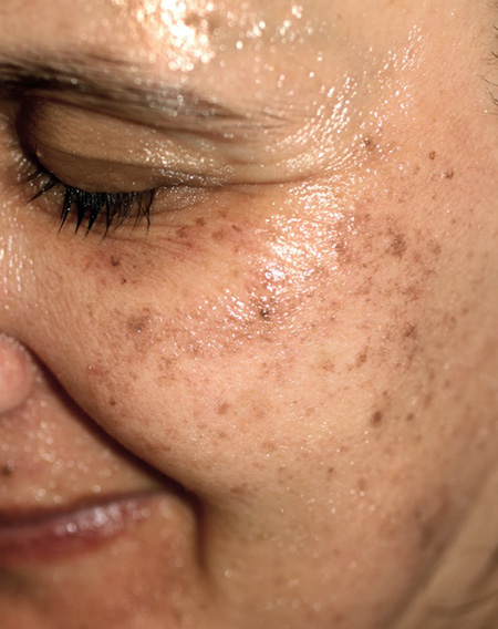Skin pigmentation on face