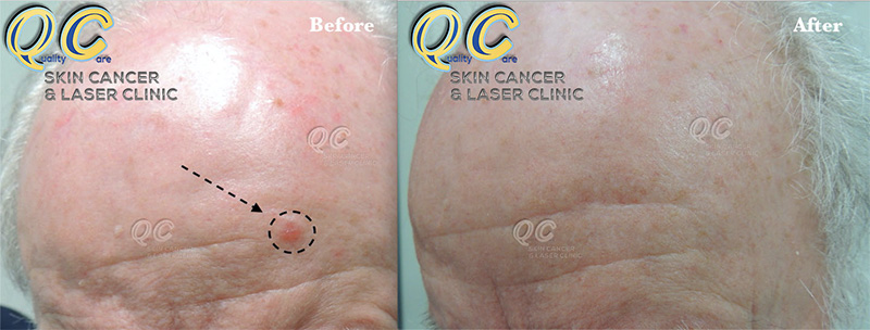 Skin Cancer Clinic Rowville Remove Skin Cancer