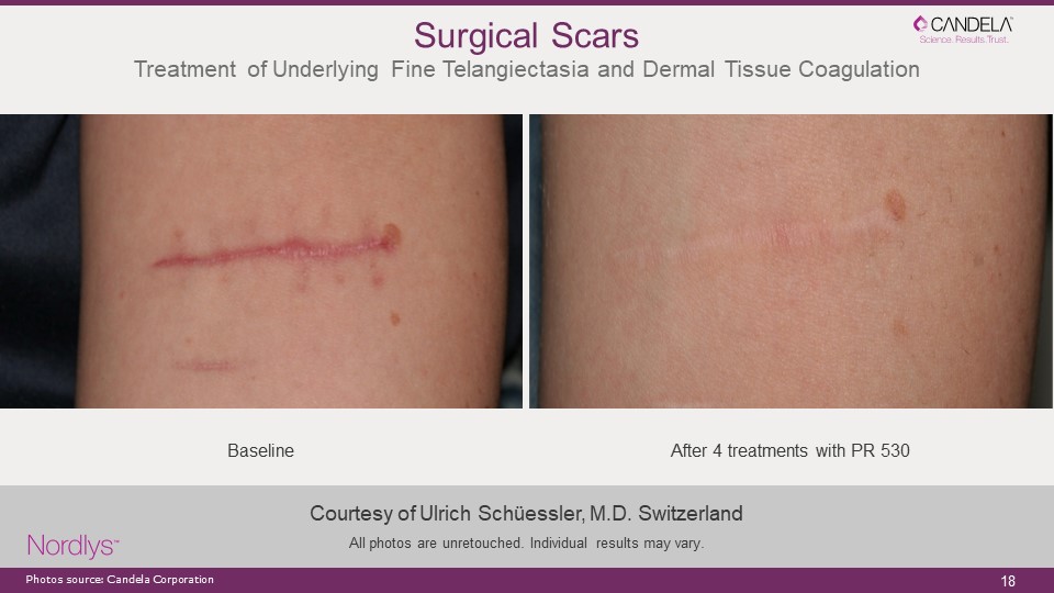 How to Get Rid of Surgical Scars? - New Image Beauty Bar