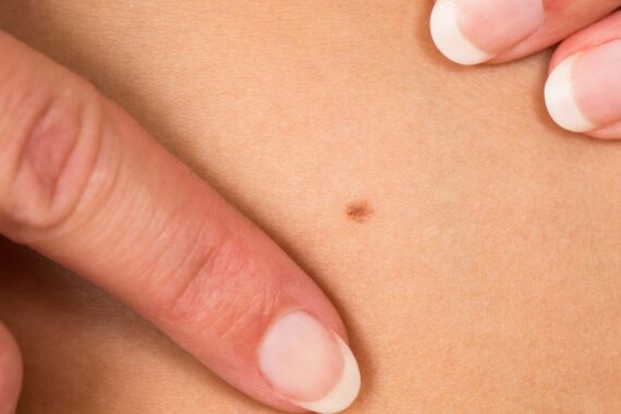 How To Check For Skin Cancer At Home Close Up Skin