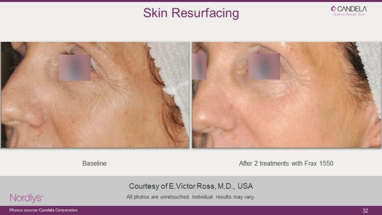 Fraxel Laser Skin Resurfacing - Skin Cancer Clinic Melbourne